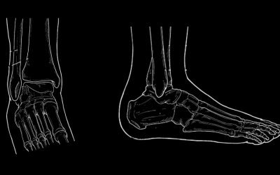 ANKLE FRACTURES