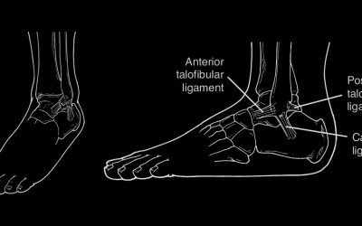 ANKLE SPRAIN
