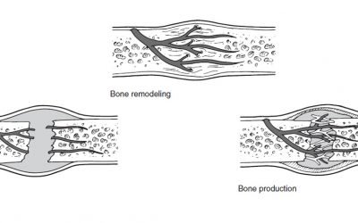 BONE HEALING