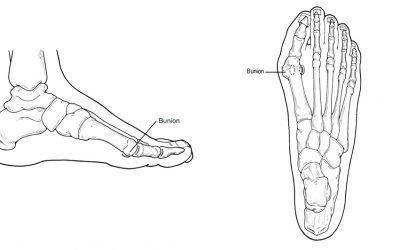 BUNIONS